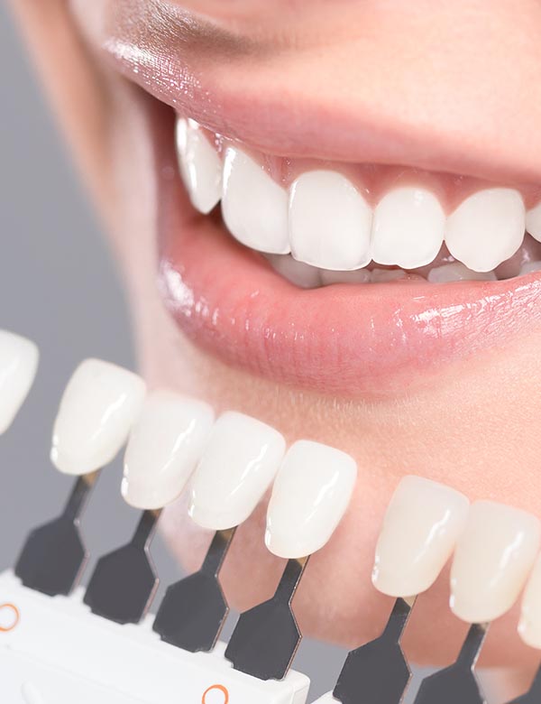 Blanqueamiento dental torremolinos