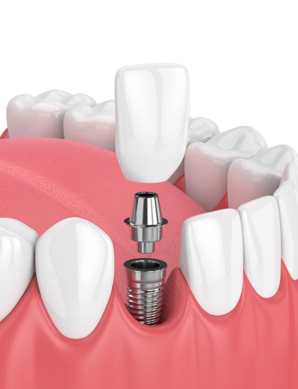 Implante dental en torremolinos