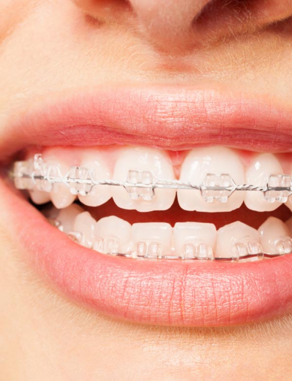 Brackets zafiro en torremolinos