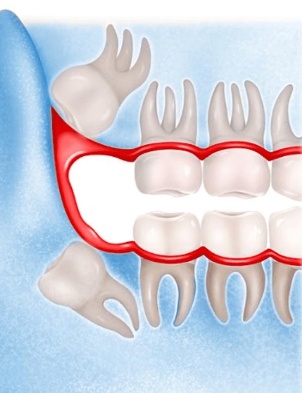 Cirugia de cordales impactados torremolinos