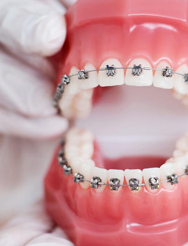 ortodoncia brackets metalicos en torremolinos