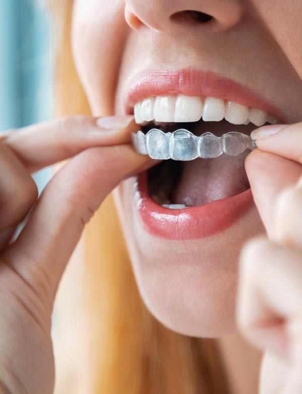 Ortodoncia invisible invisalign Torremolinos