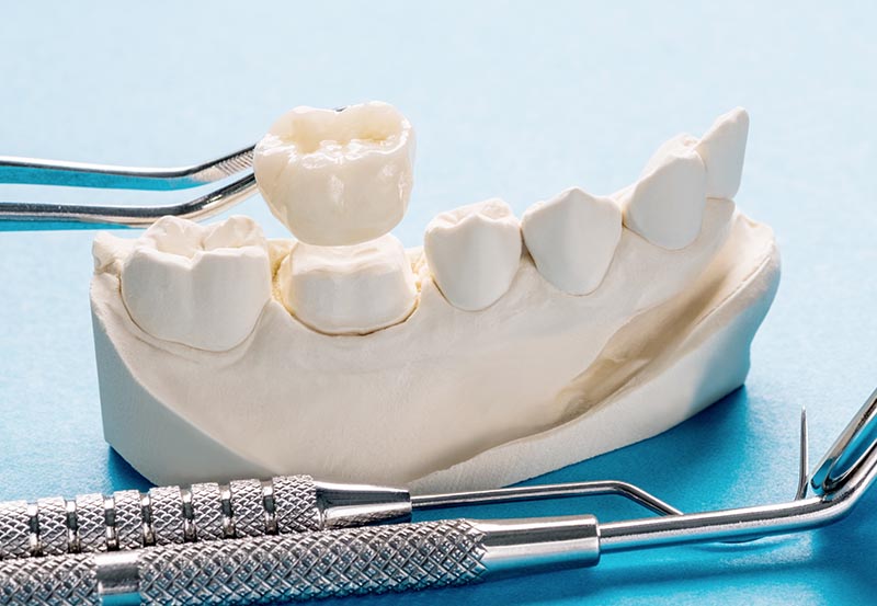 Corona dental torremolinos
