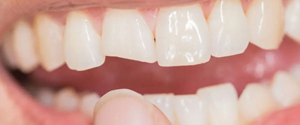 carillas dentales composite torremolinos